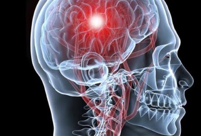 Dia Mundial do AVC é celebrado neste 29 de outubro e neurologista do HU fala sobre o tema